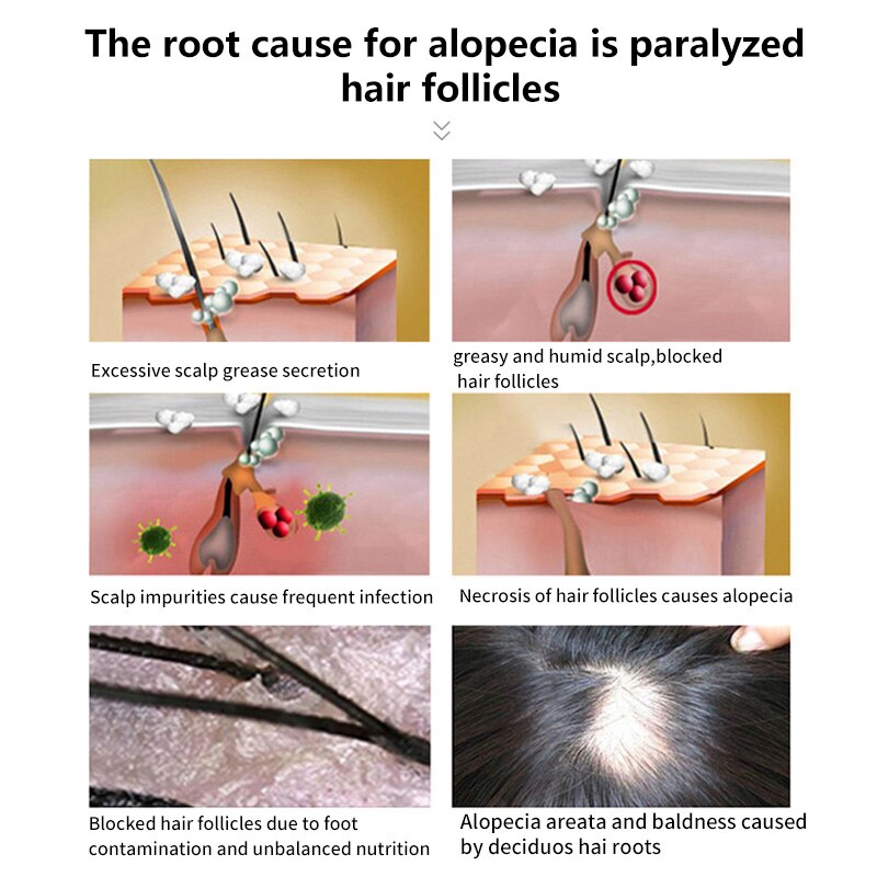 Minoxidil para el crecimiento capilar y barba